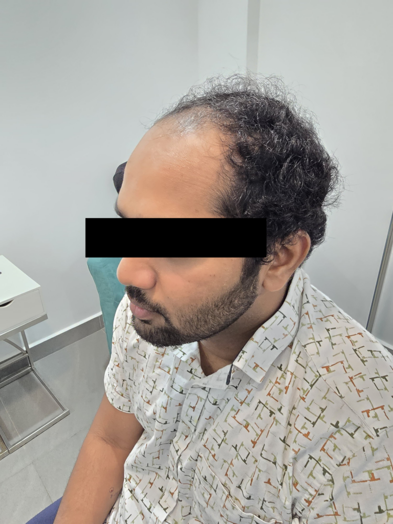 Hair transplant before Coming to Dr Hair Dr Tharindu