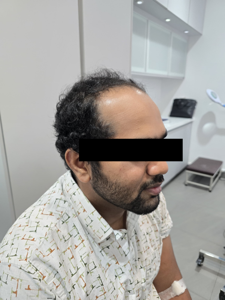 Hair transplant before Coming to Dr Hair Dr Tharindu