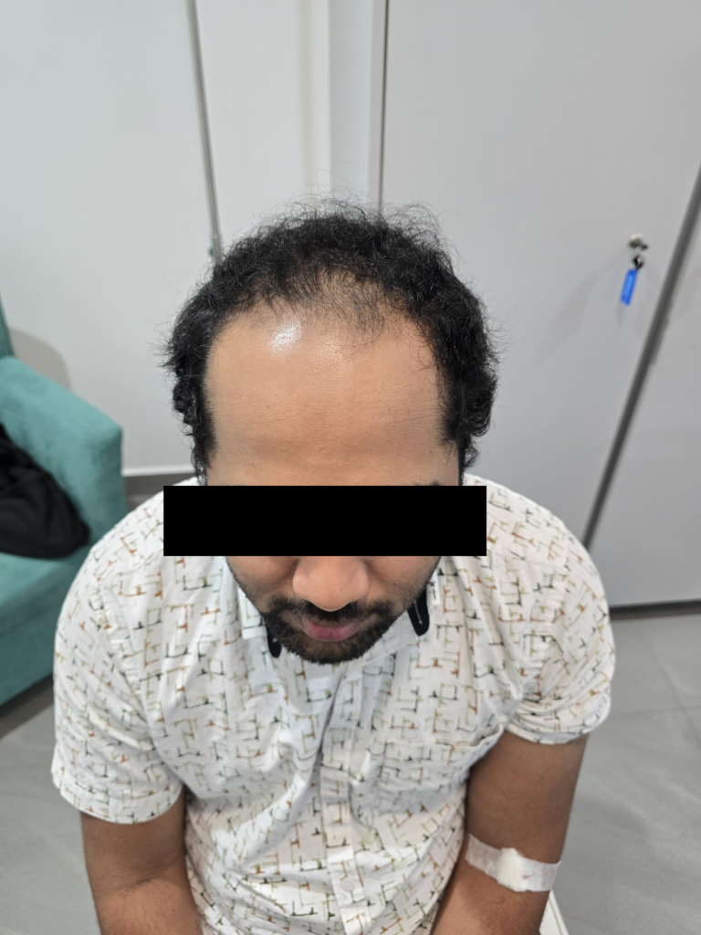 Hair transplant before Coming to Dr Hair Dr Tharindu