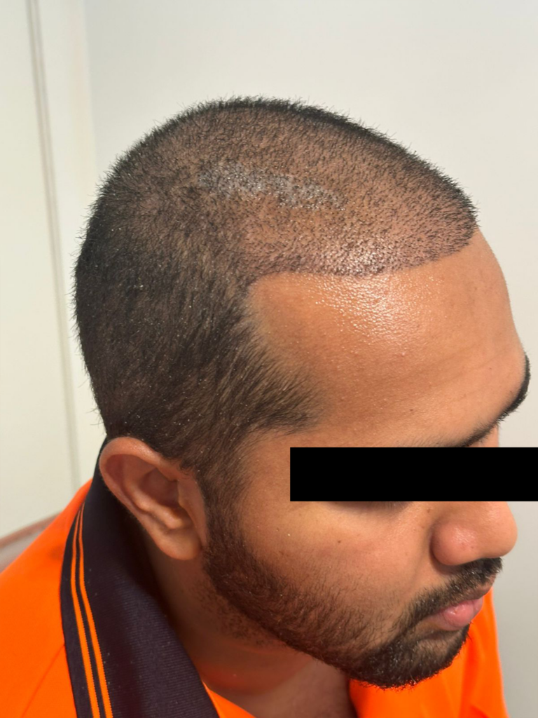 After Image result of Hair Transplant done by Dr Hair Dr Tharindu