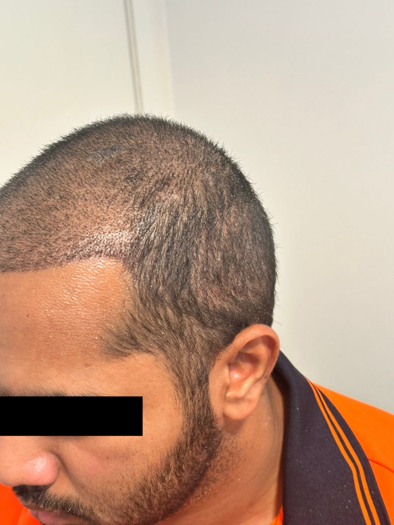 After Image result of Hair Transplant done by Dr Hair Dr Tharindu