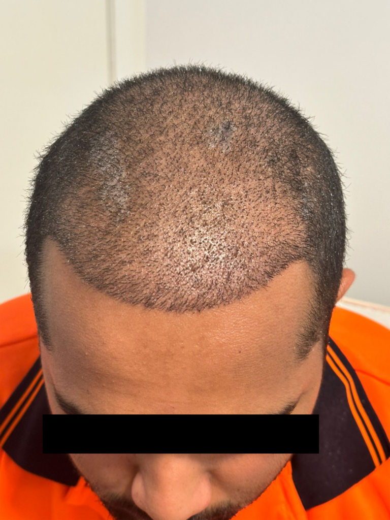 After Image result of Hair Transplant done by Dr Hair Dr Tharindu